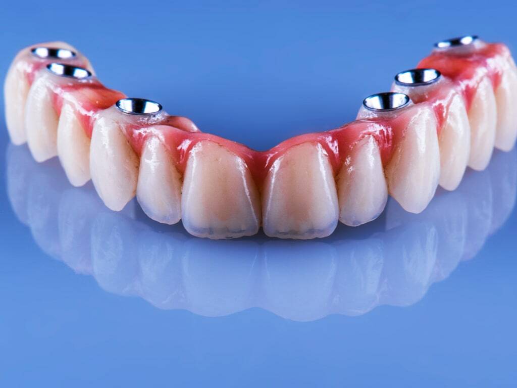 Bridge complet sur implants - Centre dentaire Suresnes